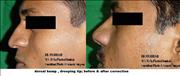  Before After Pictures,Nose job,Rhinoplasty,Delhi,hump or bumpy nose